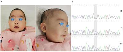 A de novo Variant of ASXL1 Is Associated With an Atypical Phenotype of Bohring-Opitz Syndrome: Case Report and Literature Review